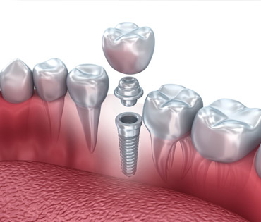 Implantate - ein Gewinn an Lebensqualität