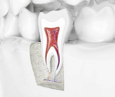 Zahnerhaltung durch Wurzelbehandlung oder Zahnfüllung
